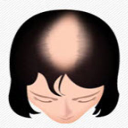 Scalp Micropigmentation For Woman-Icon