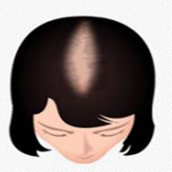 Scalp Micropigmentation For Woman Hair Loss